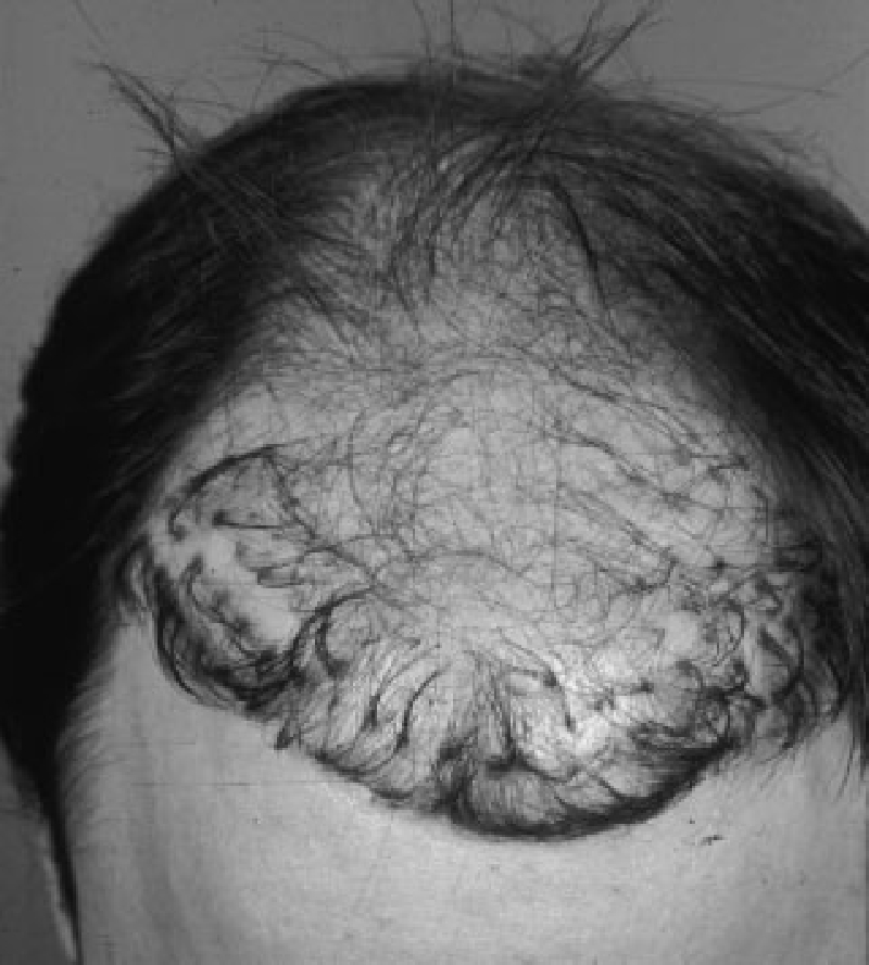 Repair-кейс — до и после ревизии неудачной пересадки