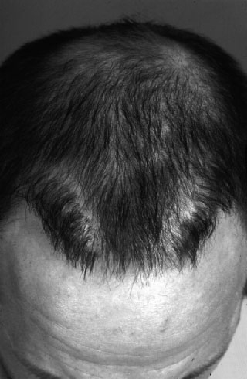 Repair-кейс с устранением низкого hairline