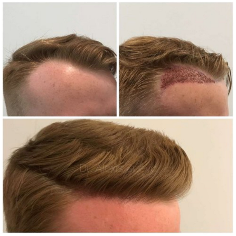 До и после пересадки — типичный визуальный эффект