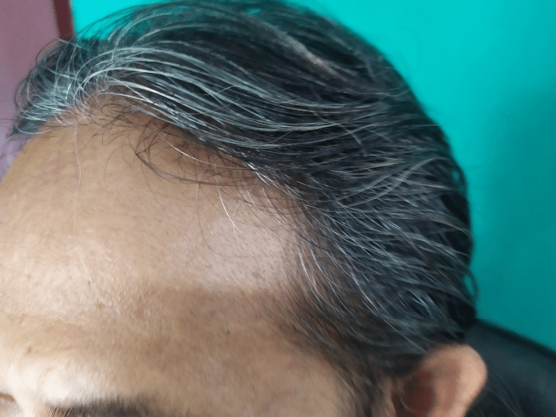 Восстановление отступившей передней линии