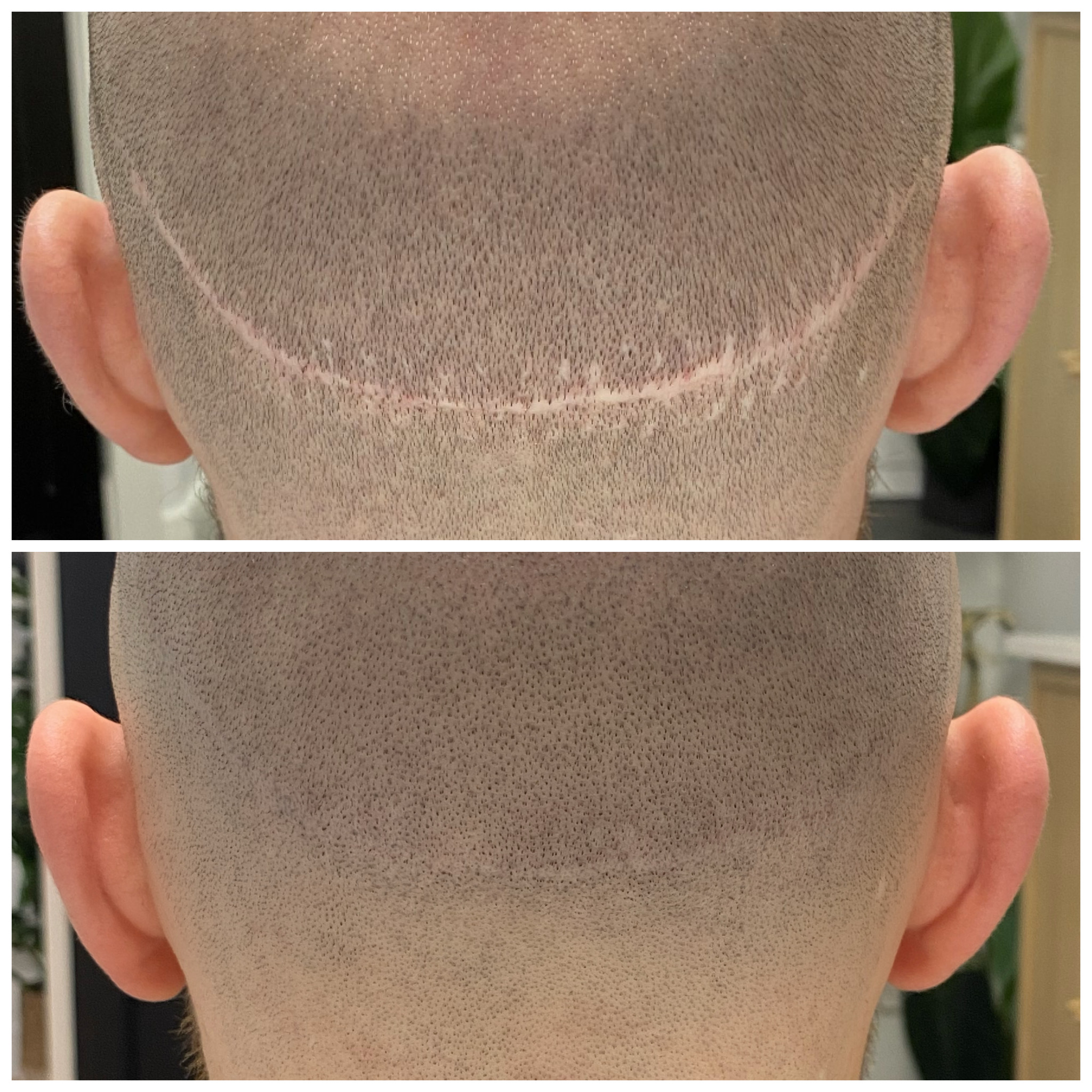 SMP — scalp micropigmentation, маскировка рубцов