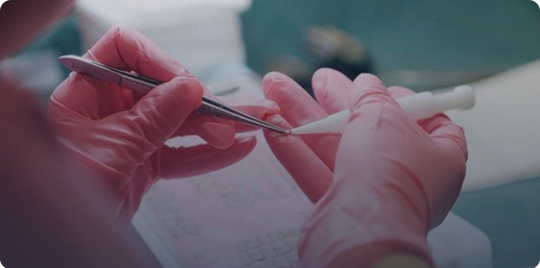 DHI Hair Transplant с Choi pen